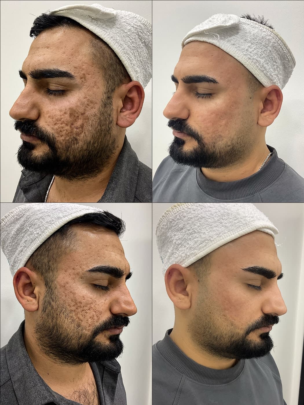 Akne & Scar Görünümü