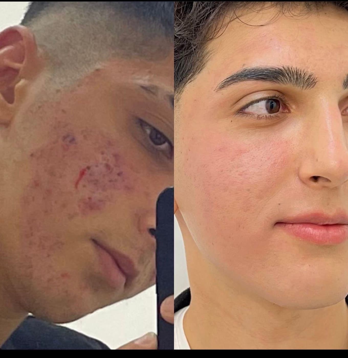 MoonQueen danışanında bakım öncesi ve sonrası 1