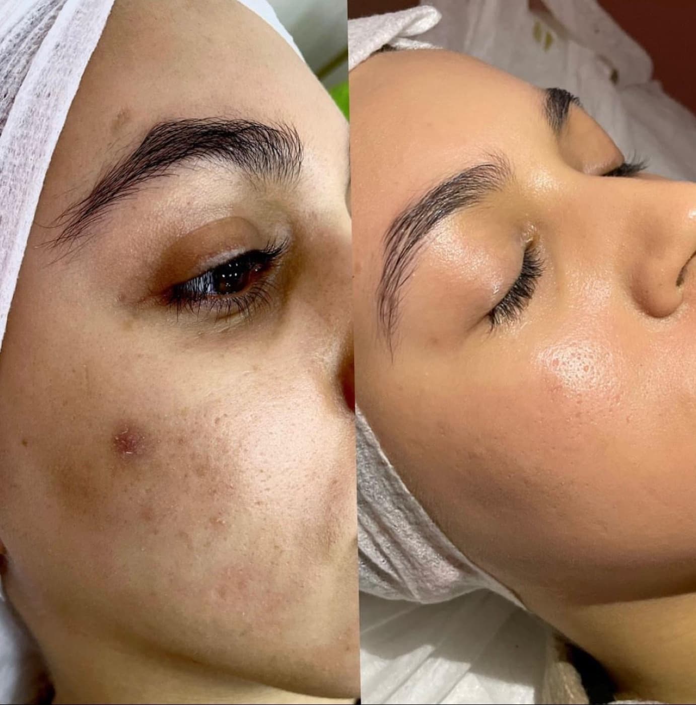 Leke ve ton eşitsizliği: MoonQueen bakım süreci öncesi ve sonrası